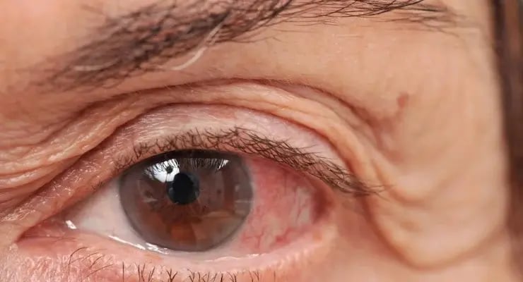 Ojo humano con pterigion o carnosidad ocular visible en la conjuntiva