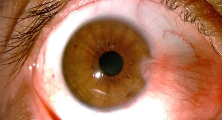 Primer plano de ojo humano con signos visibles de retinopatía diabética