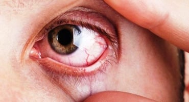 Ojo humano con enrojecimiento y vasos sanguíneos visibles en la esclerótica