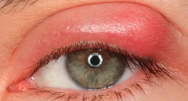 Primer plano de un ojo humano con enrojecimiento e inflamación en el párpado superior.