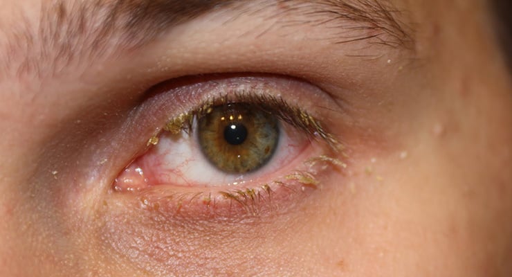 Primer plano de un ojo con enrojecimiento y secreción visible en el párpado