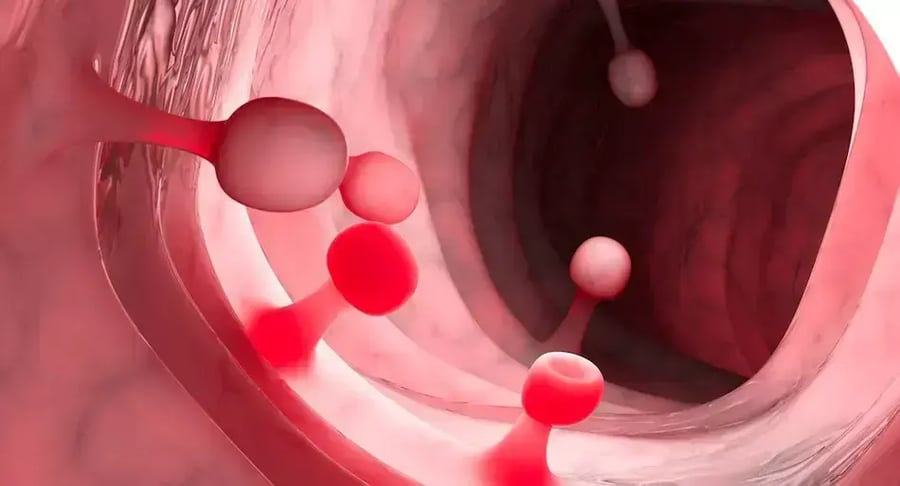 Ilustración médica de pólipos en el colon que requieren polipectomía