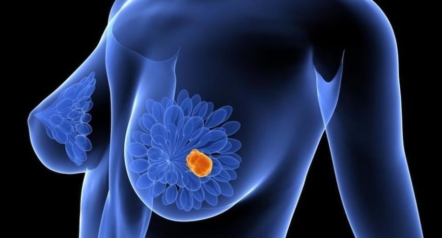 Ilustración médica en 3D del torso femenino resaltando la glándula mamaria y un tumor de color naranja brillante, representando la detección de cáncer de mama.