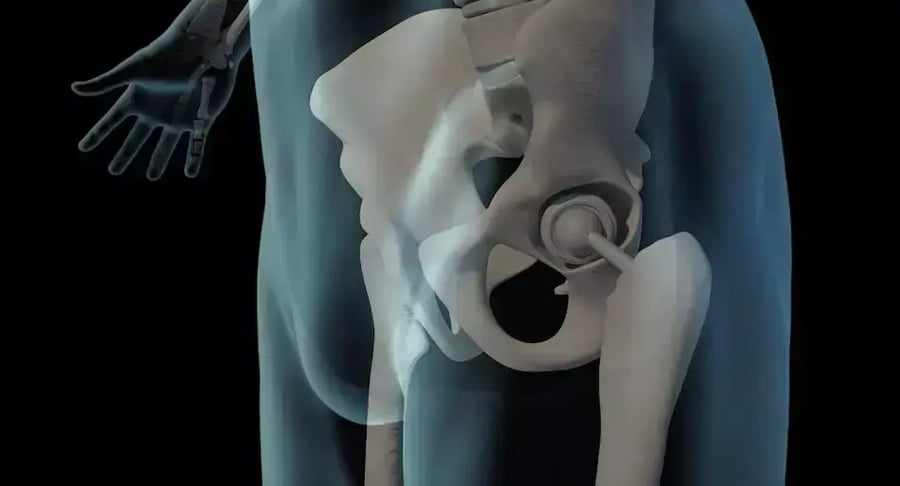 Radiografía que muestra prótesis de cadera en el cuerpo humano