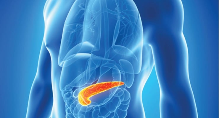 Ilustración médica en 3D del torso humano que muestra el páncreas resaltado en color naranja brillante, indicando su ubicación y posible inflamación.