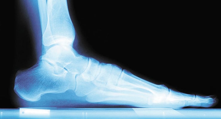 Radiografía lateral del pie humano apoyado sobre una superficie