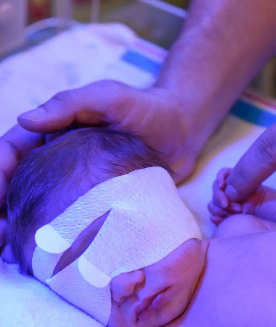 Recién nacido en incubadora con antifaz protector bajo fototerapia neonatal