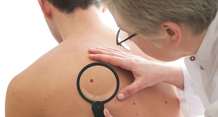 Médico examinando una lesión en la piel con lupa durante revisión de cáncer de piel.