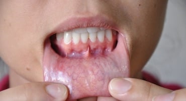 Persona mostrando la parte interna del labio inferior con una lesión visible