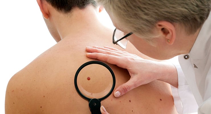 Dermatólogo examinando un lunar en la espalda de un paciente con una lupa.