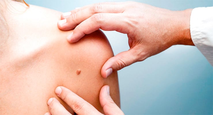 Médico examinando un lunar en el hombro de una persona durante revisión dermatológica