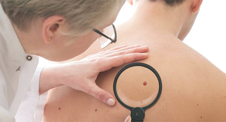 Médico examinando un lunar en la espalda de una persona con una lupa