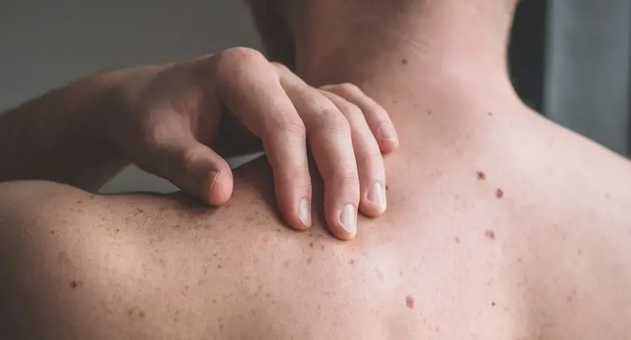 Hombre con lunares visibles en la espalda revisando su piel para prevención de cáncer