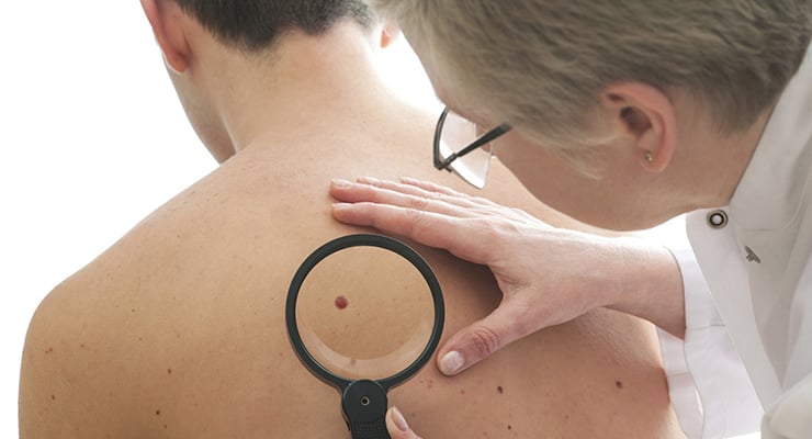 Profesional de salud examinando lunares en la espalda de una persona con una lupa.