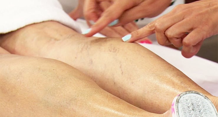 Detalle de piernas con venas visibles mientras una persona señala áreas específicas durante revisión médica.