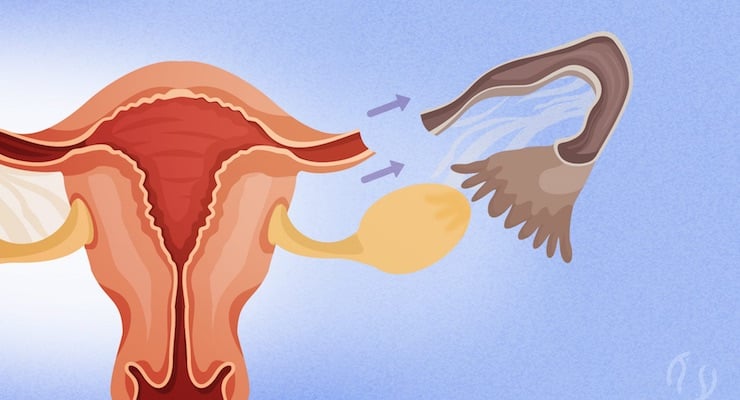 Ilustración médica del útero y trompas de Falopio mostrando procedimiento quirúrgico