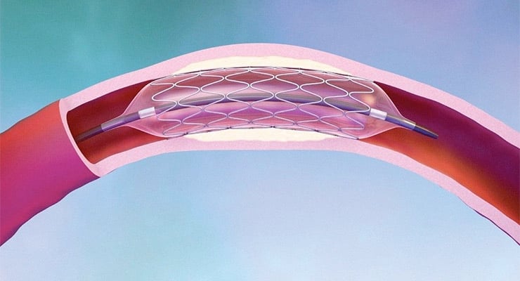 Ilustración médica de una arteria con un stent expandido en su interior para mantener el flujo sanguíneo.