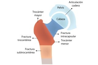 Esquema anatómico de la cadera con tipos de fractura femoral