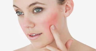 Mujer señalando el enrojecimiento por rosácea en su mejilla para consulta dermatológica.