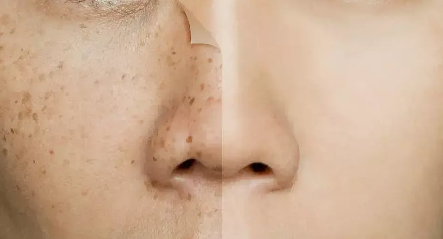 Rostro femenino con manchas en la piel antes y después de tratamiento dermatológico