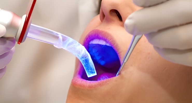 Procedimiento odontológico con lámpara de luz azul en tratamiento dental