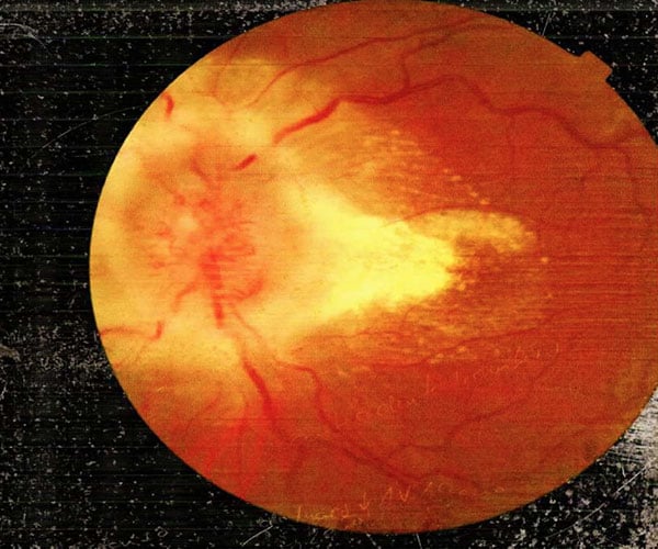 Fotografía de fondo de ojo con alteraciones vasculares