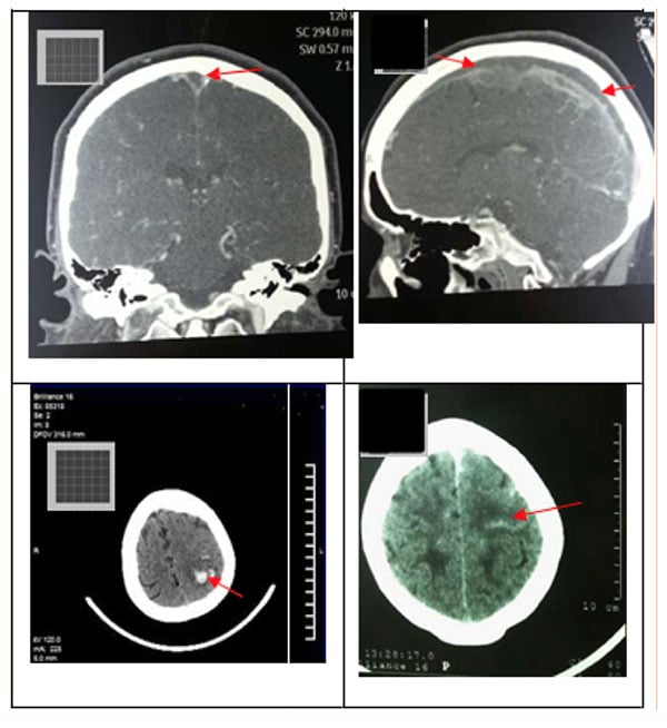 Tomografías cerebrales con flechas señalando zonas afectadas por trombosis