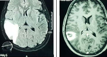 Imágenes de resonancia magnética (RM) y tomografía computarizada (TC) de un cerebro humano que muestran una lesión parietal y edema secundario a un infarto venoso.