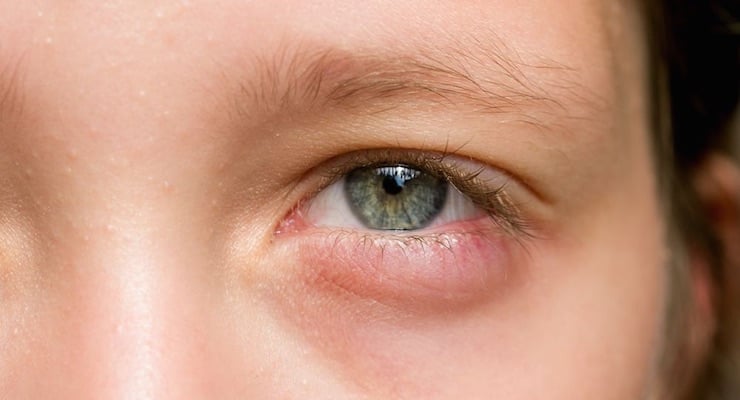 Primer plano de ojo enrojecido con vasos sanguíneos visibles en el párpado inferior