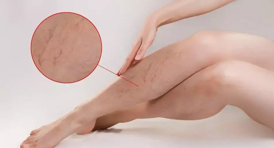 Piernas de mujer con várices visibles y acercamiento a las venas dilatadas