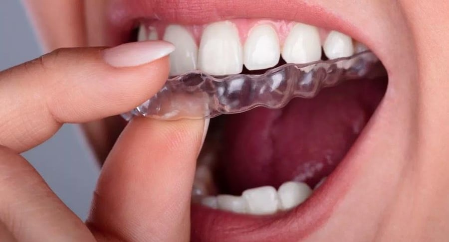 Primer plano de una persona colocando un alineador de ortodoncia invisible sobre sus dientes superiores para un tratamiento dental estético.
