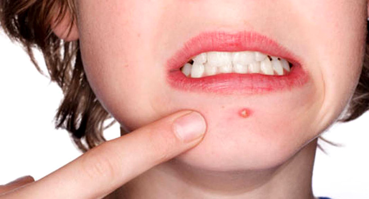 El acné tiene cura, conozca los tratamientos