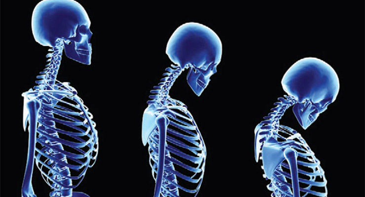 ¿Qué es y cómo podemos prevenir la osteoporosis?