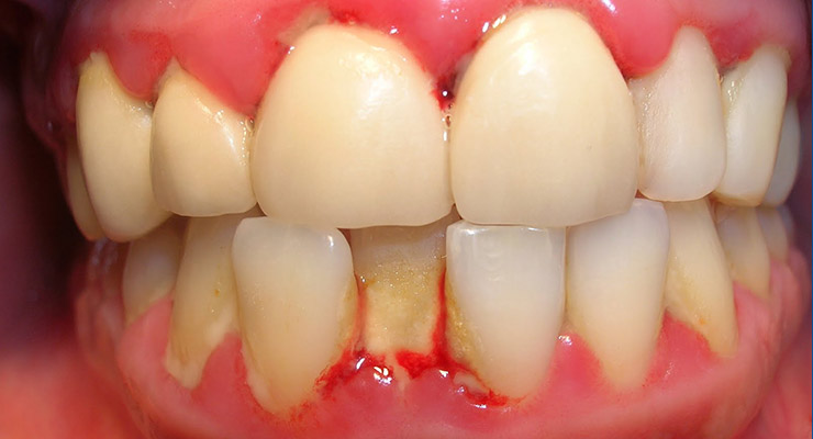 Evite la gingivitis con buenos hábitos de limpieza dental