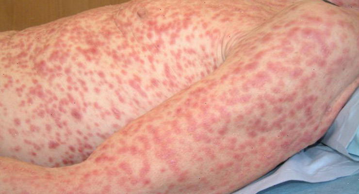 La sífilis es una enfermedad silenciosa que puede traer graves problemas