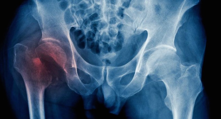 Fractura de cadera