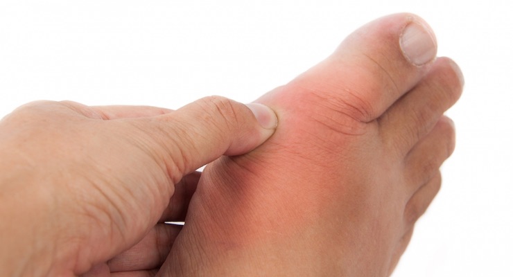 Recomendaciones no farmacológicas para el tratamiento de la gota