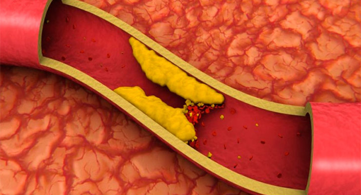 Grasa en las arterias