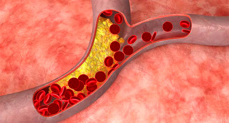 Qué sabemos de la acumulación de grasa en las arterias