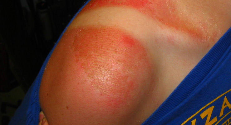 Las zonas más afectadas por el sol: la cara y los brazos