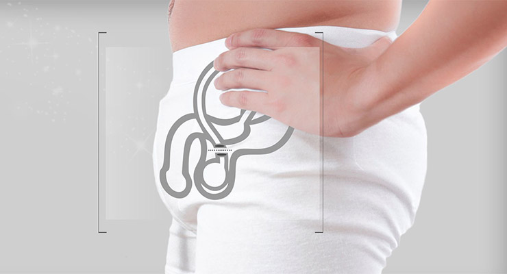 Vasectomía, método anticonceptivo para hombres