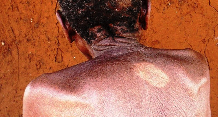 La piel, los nervios y los ojos se pueden ver afectados por la lepra