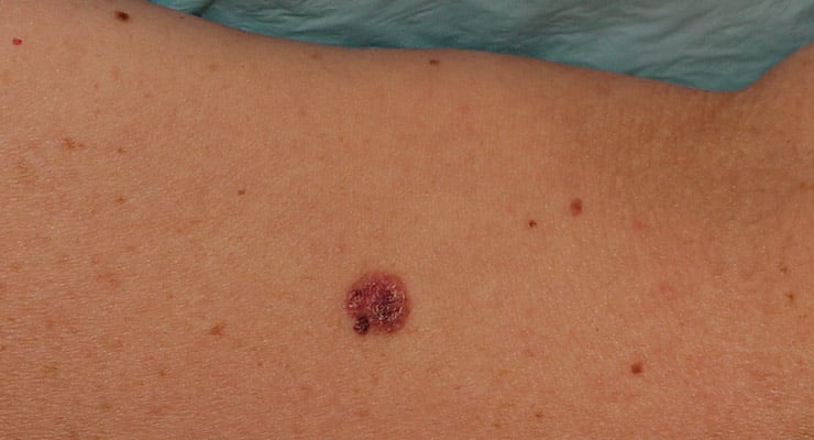 Monitoree sus lunares y evite sufrir de melanoma