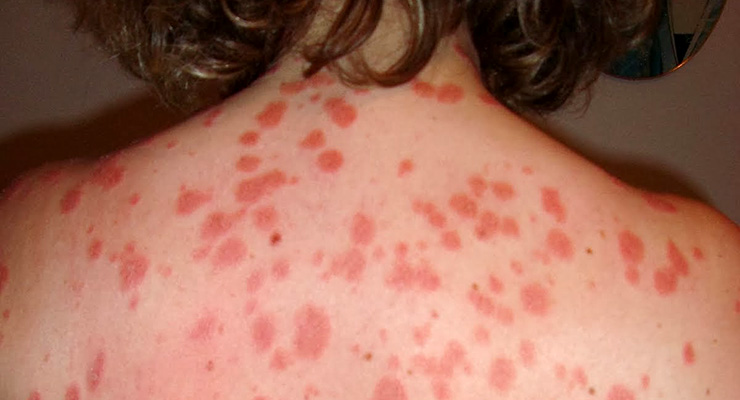 El cuidado de la piel puede aliviar molestias de psoriasis