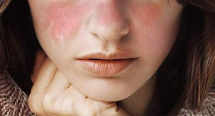 ¿Ha escuchado usted hablar sobre el Lupus?