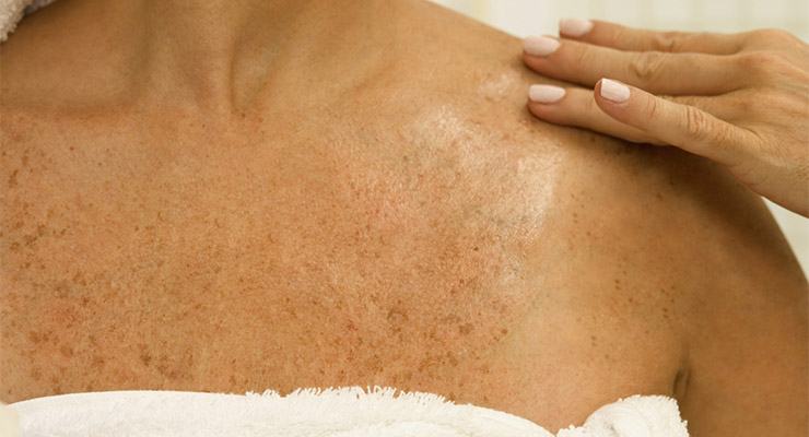 La exposición al sol produce manchas y la aparición de arrugas