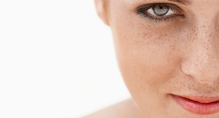 Manchas en la piel o lentigo