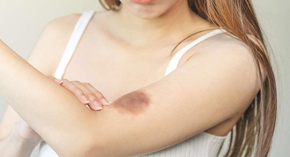 Moretones que aparecen sin razón