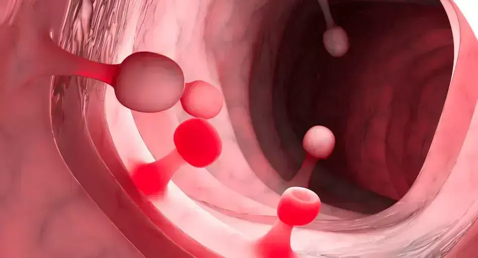 Prevención y tratamiento de pólipos en el colon: qué son y cómo se detectan