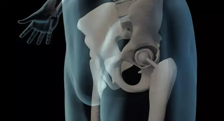 Reemplazo de cadera: qué es y cómo recuperar tu movilidad